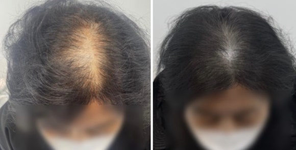 여성두피문신? 60대 실제 사례 사진으로 확인하세요 관련 이미지 1