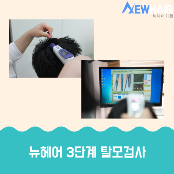 탈모검사 제대로 받고 치료하자 관련 이미지 3