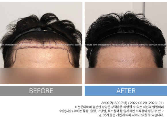 하루에 담배 00개비 피우면 탈모로 대머리 된다? 관련 이미지 7