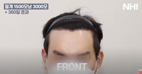 [뉴헤어] 모발이식 1500모낭 1년 후 사진 공개 l M자 엠자 남성탈모 관련 이미지 2