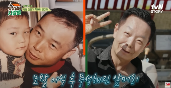 이식된 머리카락, 왜 잘 안 빠질까? 공여부 선택의 비밀(김학래씨 모발이식) 관련 이미지 2