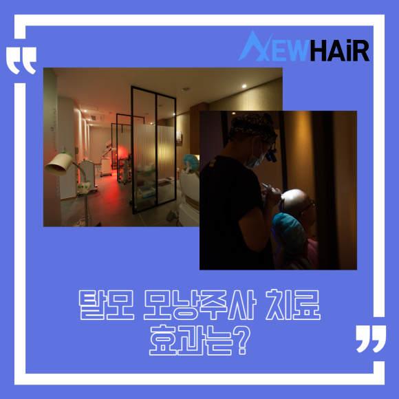 탈모 모낭주사 치료 효과는? 관련 이미지 1