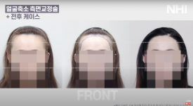 이마축소! 얼굴 작아지는 헤어라인교정 l 여자 모발이식 전후 사진 보기 관련 이미지 3