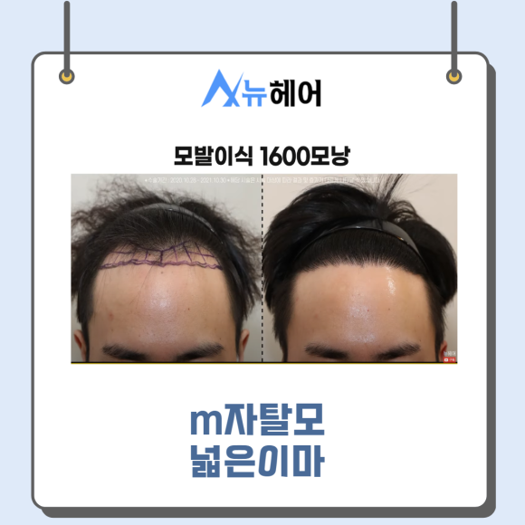 강남모발이식 m자교정 빈틈없이 빽빽하게 관련 이미지 2