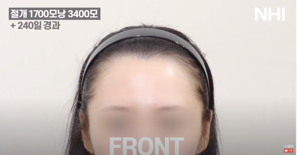 [뉴헤어] 여자 모발이식 헤어라인교정 240일 후 결과 관련 이미지 2