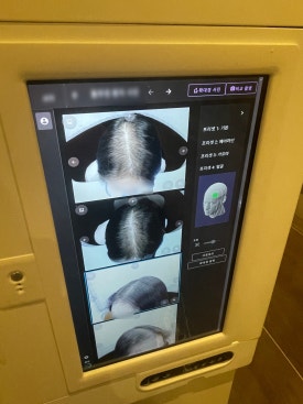 Young-Onset Hair Loss (Hair Loss in Your 20s and 30s): Why Is It Increasing? image 2
