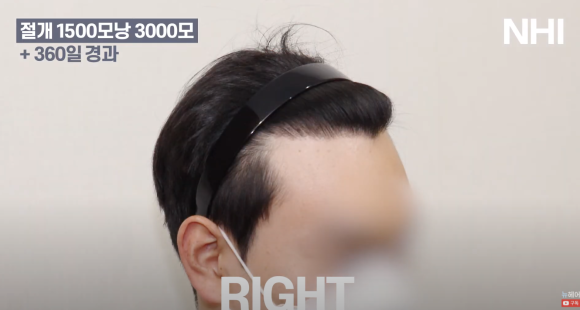[뉴헤어] 모발이식 1500모낭 1년 후 사진 공개 l M자 엠자 남성탈모 관련 이미지 4