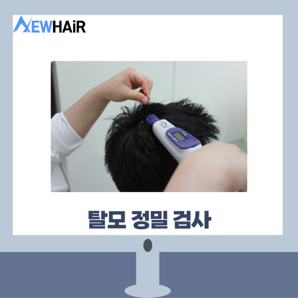 탈모검사비용 제대로 알고 치료하자 관련 이미지 5