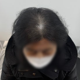 여성두피문신? 60대 실제 사례 사진으로 확인하세요 관련 이미지 12