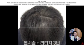 정수리탈모문신 시술직후 나타나는 효과?(전후사진) 관련 이미지 14