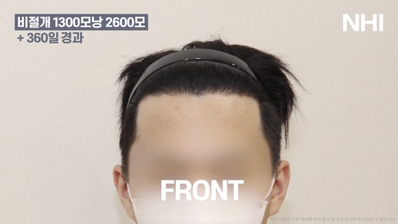 모발이식 전후 사진 l 1년 후ㅣ뉴헤어 1300모낭 관련 이미지 3