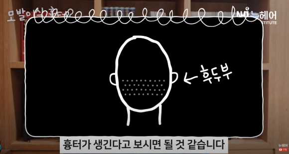 모발이식 흉터 정리 끝! 비절개 & 절개 흉터 비교 관련 이미지 12