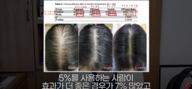 여성탈모는 남성용 미녹시딜을 써라?(효과,부작용) 관련 이미지 7