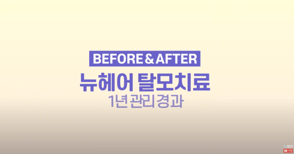 뉴헤어 탈모치료 1년 후 사진 l 정수리 탈모 l 모낭주사 l 탈모주사 관련 이미지 1