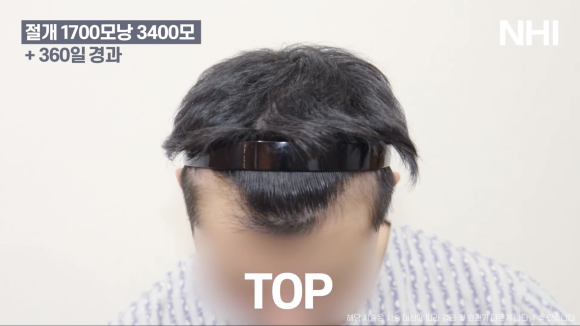 모발이식으로 엠자라인 벗어난 1년 후기 사진 l 1700모낭 이식 l 유전성탈모 관련 이미지 6