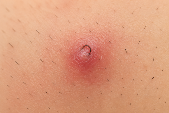 Ingrown Hair (Hair Growing Into the Skin): Inflammation and Care Methods image 1