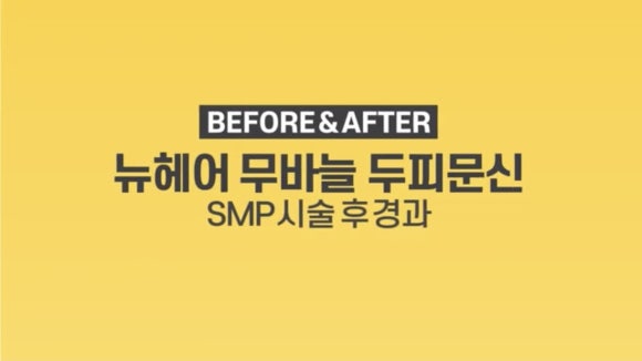 정수리 탈모 두피문신 전후 사진 / 영상 관련 이미지 1