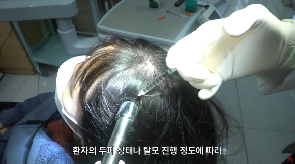 탈모 모낭주사 효과 진짜 있나요? (종류&middot;부작용) 관련 이미지 6