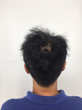 남성형 탈모 치료, 6개월 만에 이루어낸 변화 대공개 관련 이미지 9