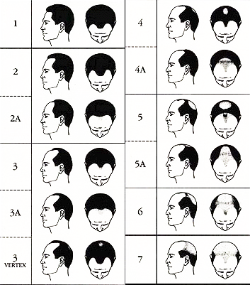 유전 탈모, 결국 대머리 되나요? 관련 이미지 1