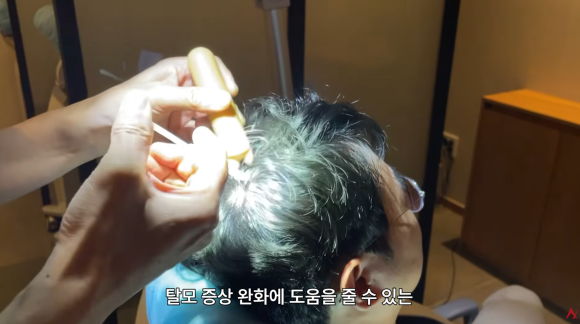 탈모 모낭주사 효과 진짜 있나요? (종류&middot;부작용) 관련 이미지 3