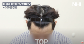 비절개 모발이식 헤어라인 엠자채우기 l 남자 탈모 모발이식 2400모 전후 사진 후기 관련 이미지 5
