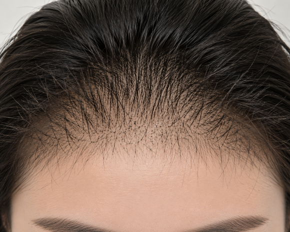 Is a Stubbly Hairline a Good Sign of Hair Growth? image 1