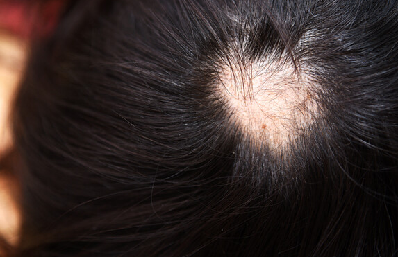 Alopecia Areata: Can Prognosis Be Predicted in Advance with an Examination? image 1