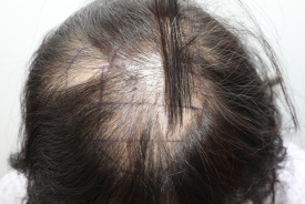 Why Are Crown Hair Transplants (Part-Line Hair Transplants) Slower to Show Results Than Other Areas? image 4