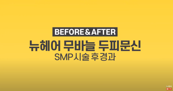 [뉴헤어] 남자 두피문신 정수리 전후사진 + 영상 관련 이미지 1