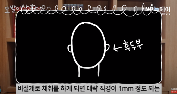 모발이식 흉터 정리 끝! 비절개 & 절개 흉터 비교 관련 이미지 10