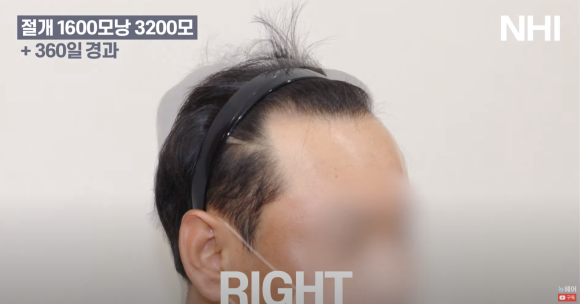 [뉴헤어] 모발이식 1600모낭 심고 1년 후 결과 l 남자 헤어라인 교정 관련 이미지 4