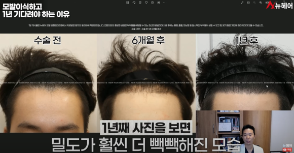 모발이식경과 1년을 기다려야 하는 이유 관련 이미지 11