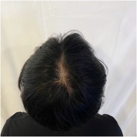 남성탈모병원? 의사는 가족에게 관련 이미지 5