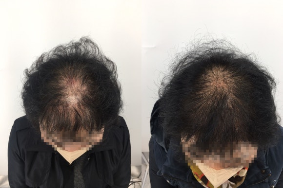 탈모모낭주사, 4달 치료받고 자신감 되찾은 50대 여성 사례 관련 이미지 1