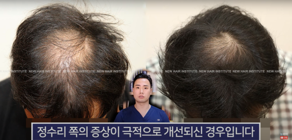 모발이식 알아봐야 한다면 관련 이미지 6