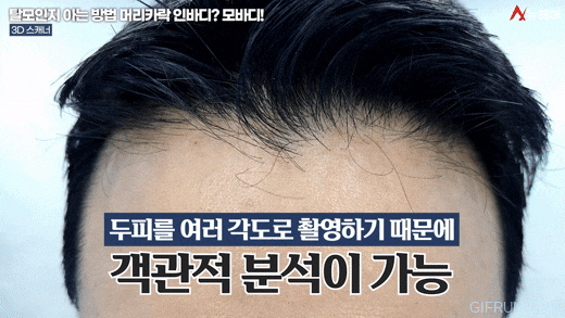 탈모 검사! 머리카락 인바디? 모바디! 관련 이미지 14