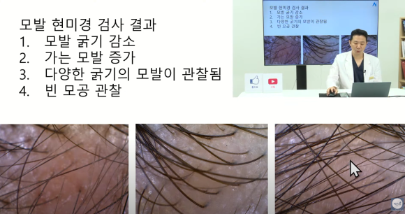 [비온뒤X뉴헤어]여성 탈모치료, 탈모 이렇게 치료해요 관련 이미지 4