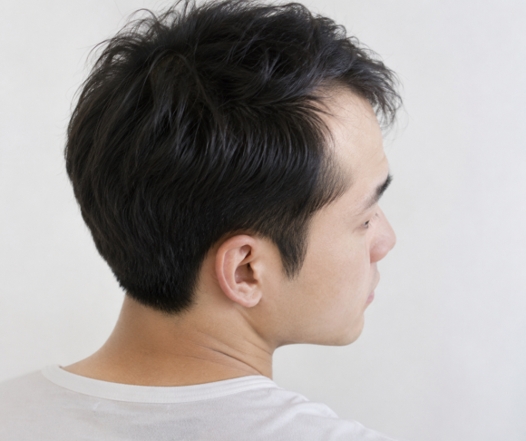 20대 M자 탈모, 약부터 먹어야 할까요? 원형탈모와 구별부터 모발이식 관련 이미지 1