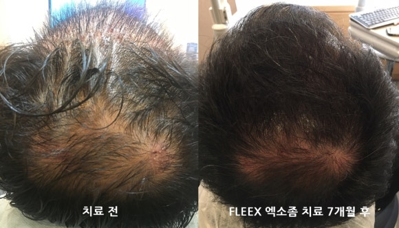 탈모치료(모낭주사) 효과 l 7개월 경과 사진 관련 이미지 1