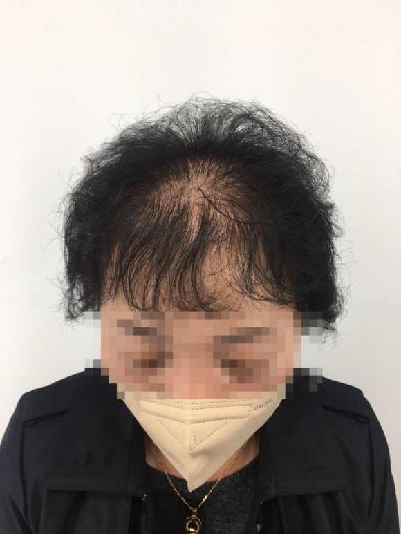 탈모모낭주사, 4달 치료받고 자신감 되찾은 50대 여성 사례 관련 이미지 3