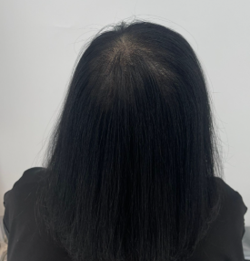 모발문신후기? 탈모치료와 병행한 40대 여성 환자분 사례 관련 이미지 11