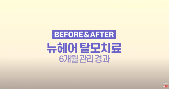 뉴헤어 탈모치료(모낭주사) 6개월 후기 l 전후사진 관련 이미지 1