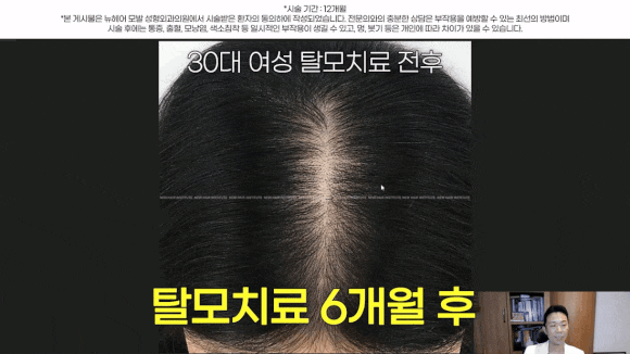 여자정수리탈모, 약 없이 치료하는 법 관련 이미지 7
