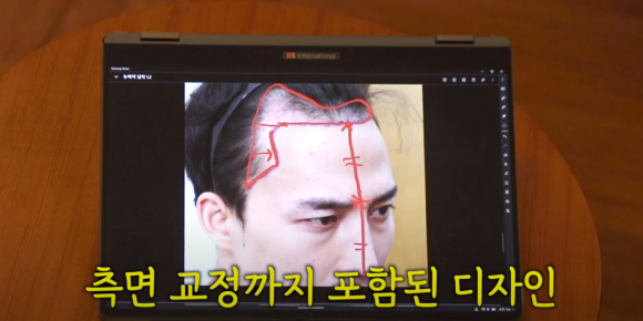 얼굴형에 따라 달라지는 모발이식 헤어라인, 황금비율이 있을까? 관련 이미지 2
