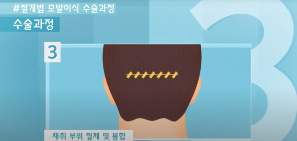 모발이식 수술 뉴헤어에서 알아보기(절개,비절개,헤어라인,모발이식방법,수술) 관련 이미지 4