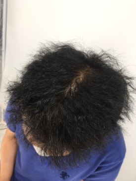 남성형 탈모 치료, 6개월 만에 이루어낸 변화 대공개 관련 이미지 5