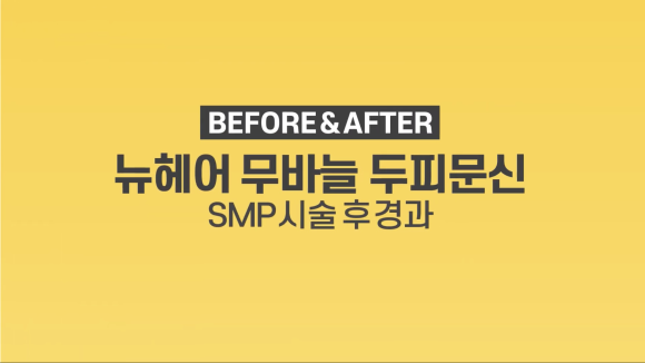 여자 두피문신 l 가르마 탈모 l 정수리 탈모 두피문신 전후 사진 l 뉴헤어 관련 이미지 1