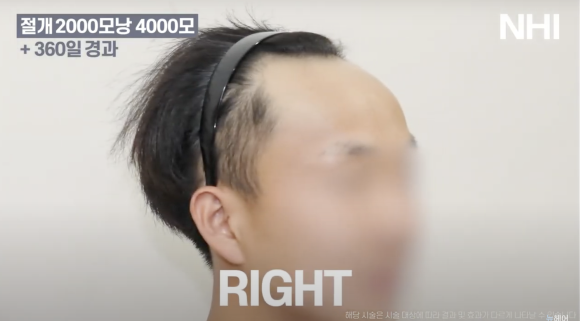뉴헤어 남자 모발이식 후기(2000모낭) 모발이식 1년 효과 후기 관련 이미지 3