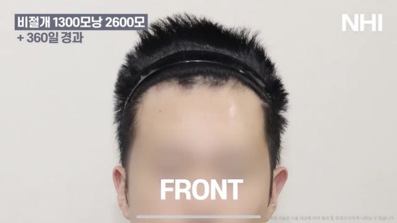 남자 앞머리 모발이식 l 탈모 모발이식 1년 전후 사진 관련 이미지 4